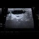 Malignant lymphoma, ultrasound of lymph nodes, correlation with CT and NM: US - Ultrasound